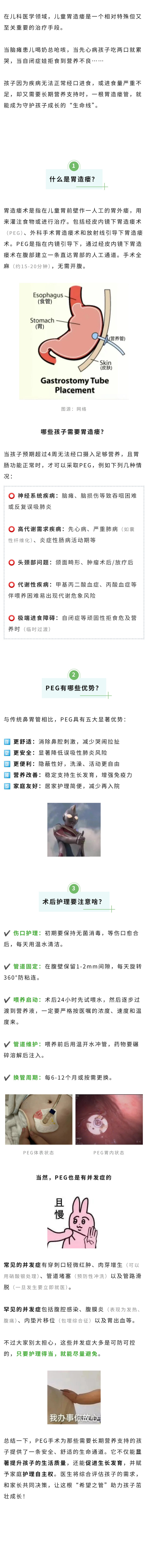 儿科  告别鼻胃管！孩子肚皮上的“隐形营养通道”.jpg